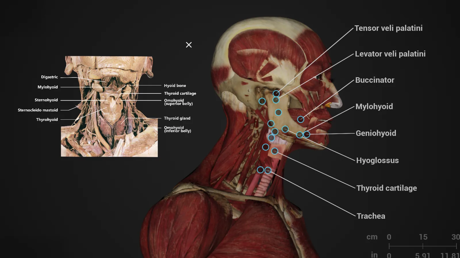 A digital model of the neck muscles with structures named, shown next to a
                    photograph of a real dissected neck labelled with the same structures.
