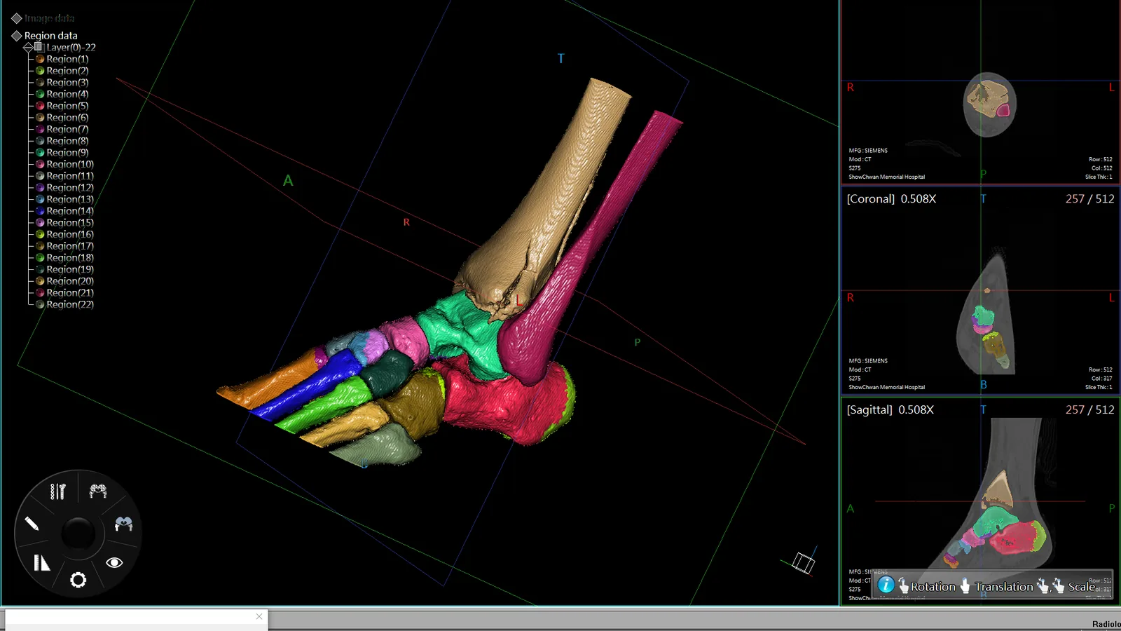 An ankle and foot CT segmented bone by bone, each tarsal and metatarsal
                    rendered in a different colour.