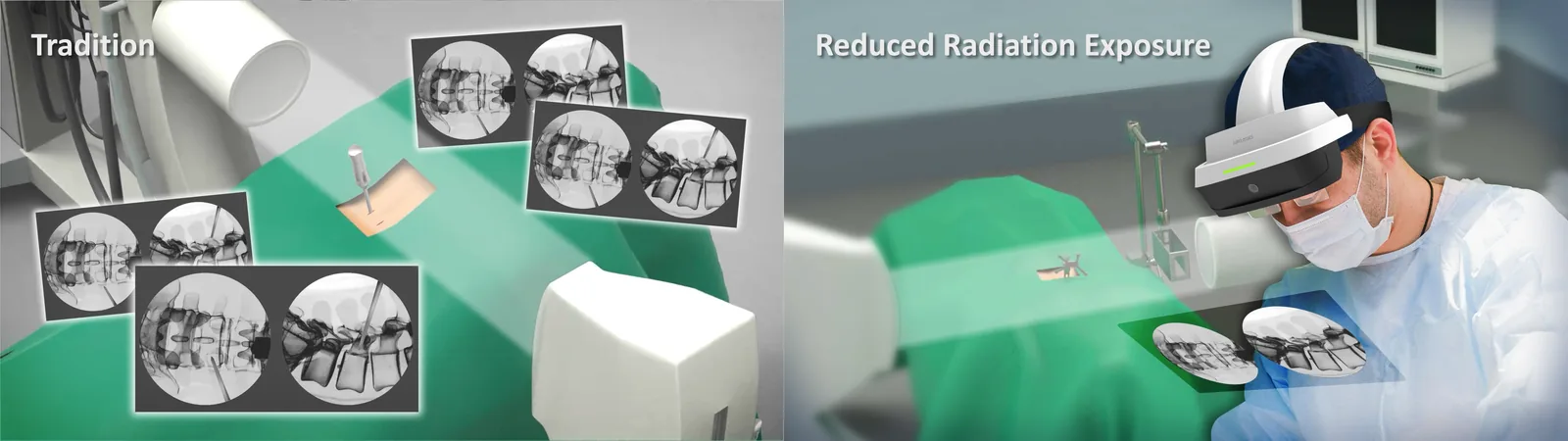 A two-panel illustration. Left, labelled tradition: a draped patient
                  surrounded by half a dozen separate fluoroscopy images. Right, labelled
                  reduced radiation exposure: the same procedure with a single pair of images
                  and the surgeon wearing a Caduceus S headset.