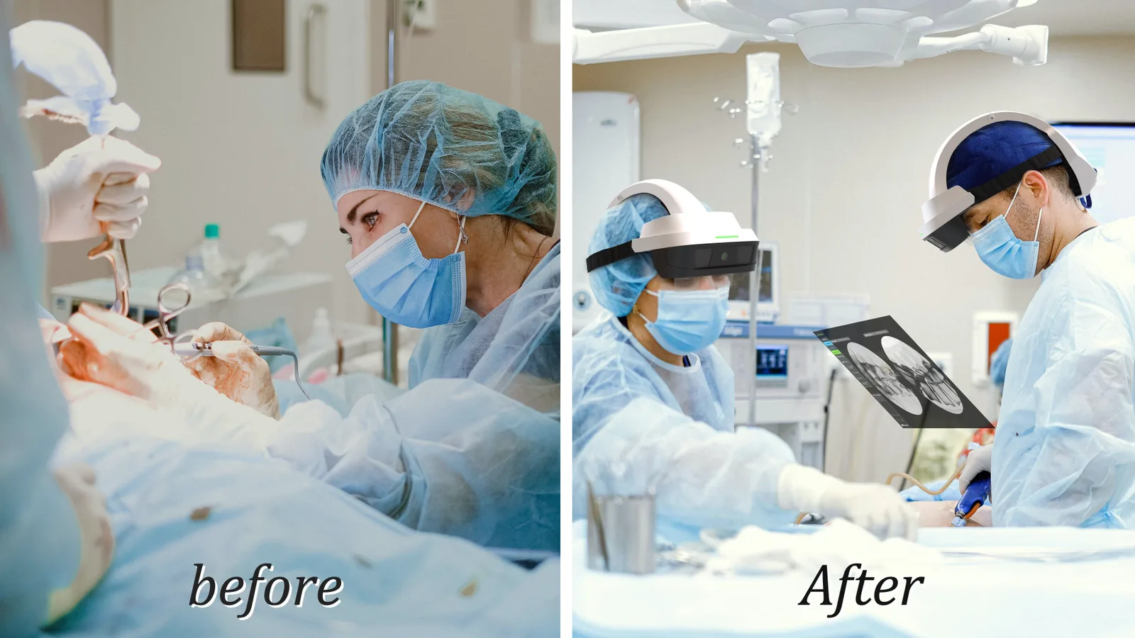 A two-panel comparison. Left, labelled before: a surgeon works with
                  instruments inside an open surgical wound. Right, labelled after: two
                  surgeons wearing Caduceus S headsets operate through a small incision with a
                  navigation panel showing spine imaging floating in front of them.
