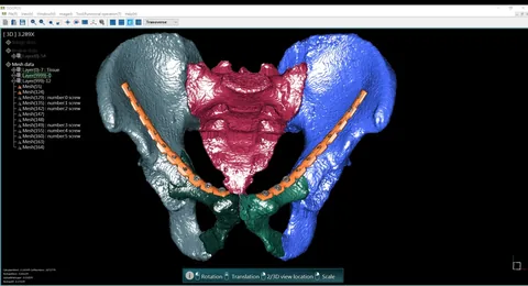 OOOPDS on screen: a segmented 3D pelvis with a bone plate planned across the fracture