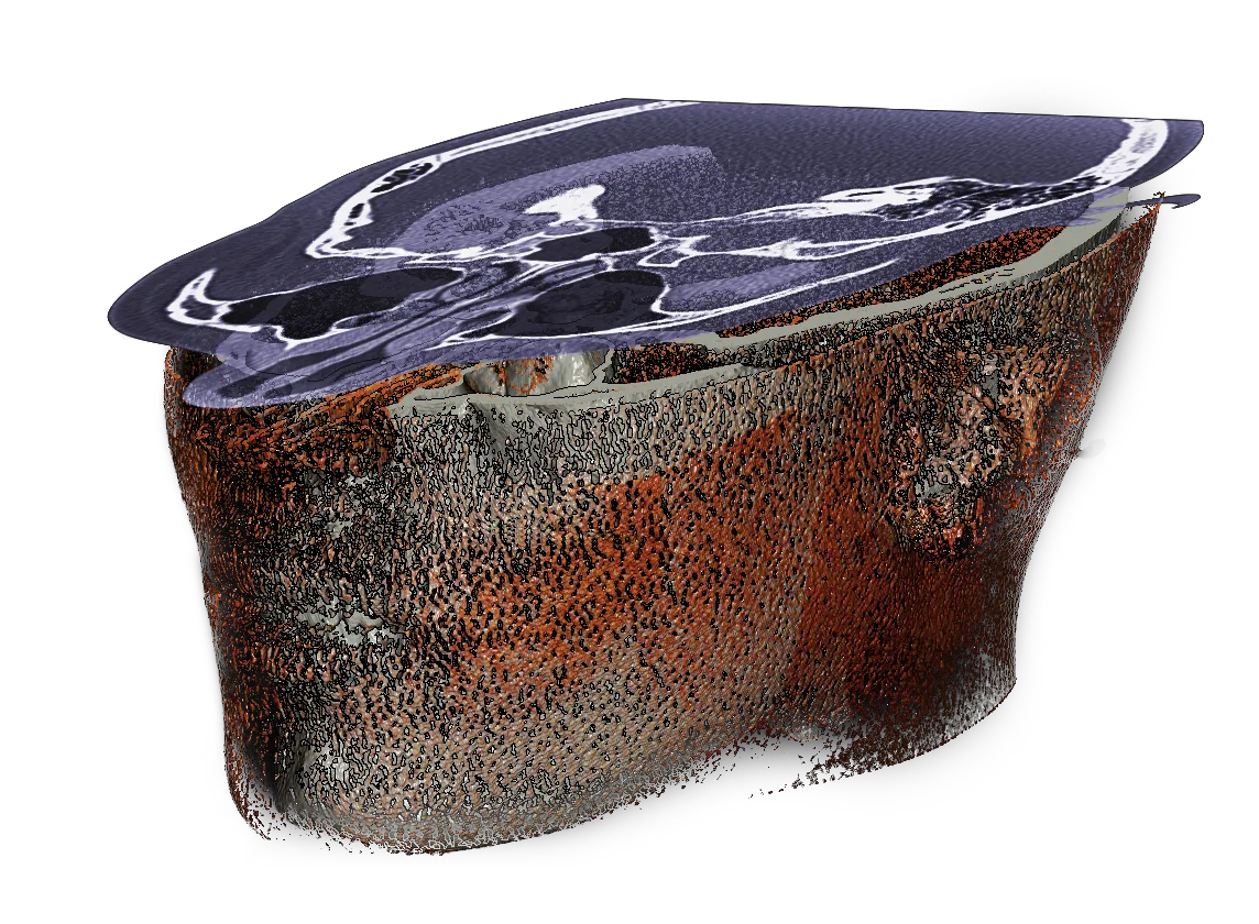 A CT volume reconstructed in OOOPDS: a block of bone rendered in three
                  dimensions with its trabecular structure visible, and a single grey-scale
                  CT slice held above it in the same coordinate space.