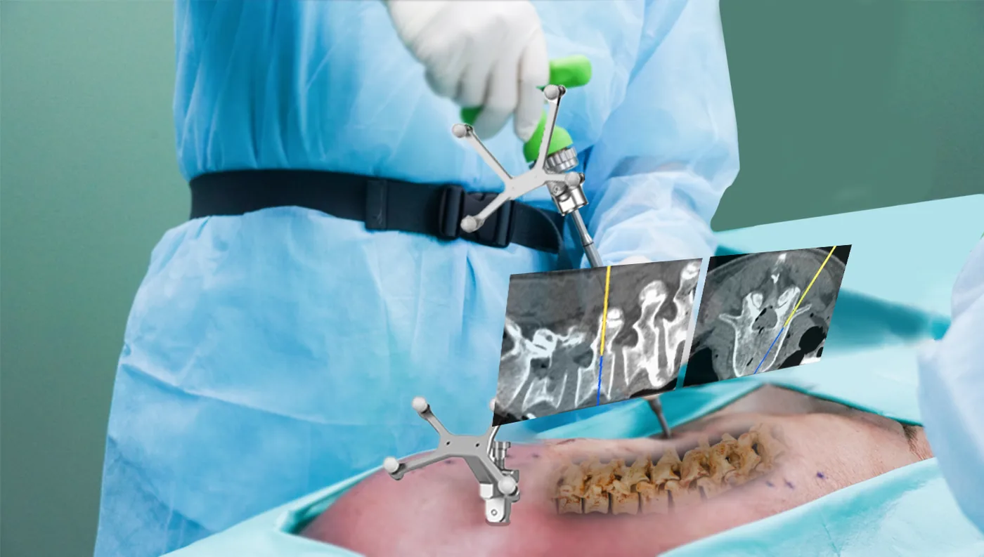 Surgeons performing a spinal procedure guided by the Caduceus S AR navigation system