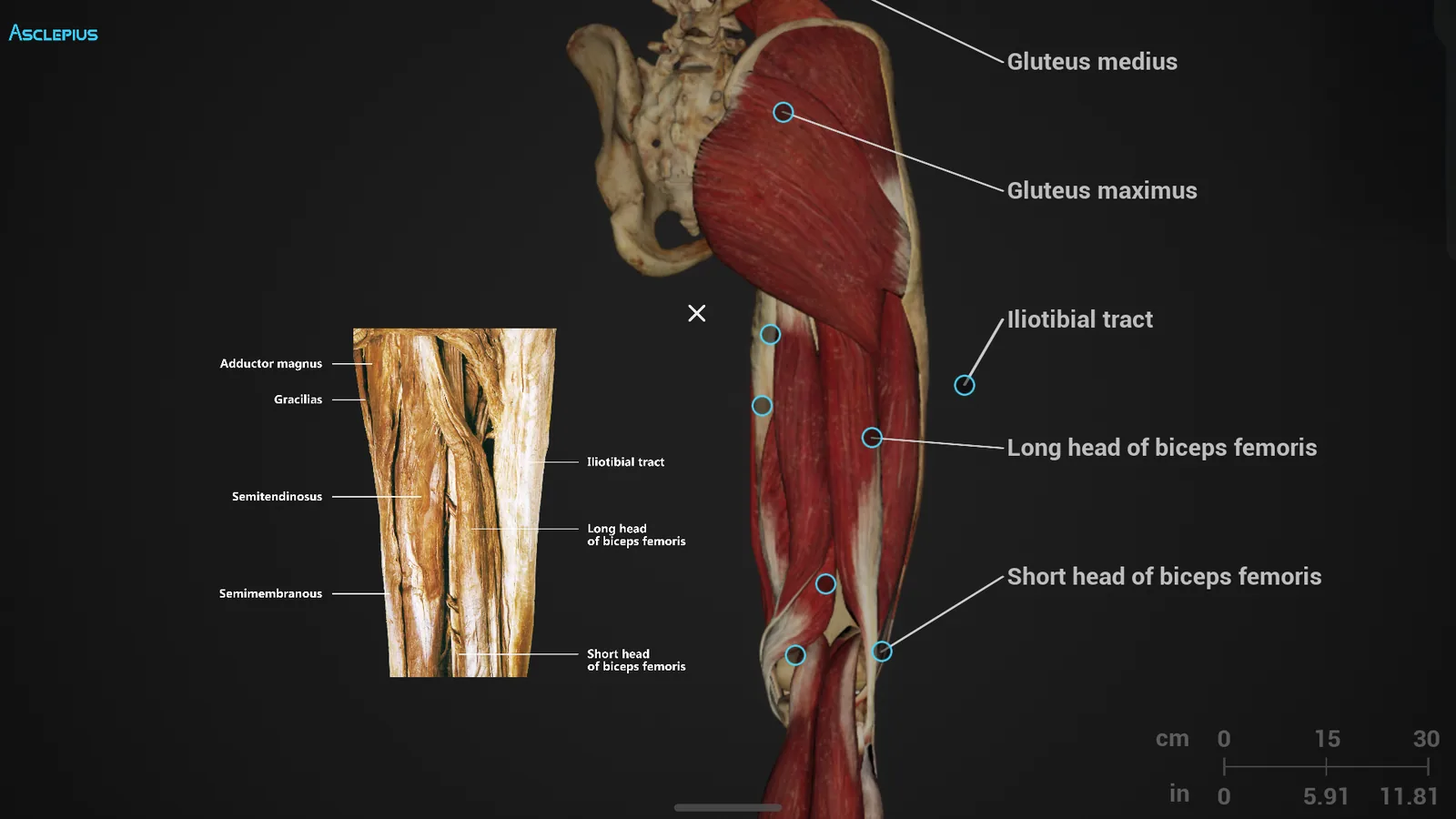 A gluteal and thigh dissection on the Asclepius table, with the digital muscle
                  model labelled &mdash; gluteus medius, gluteus maximus, iliotibial tract and
                  the heads of biceps femoris &mdash; beside the matching real-body image.